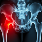 Injured hip X ray from a hip injury in Arlington VA